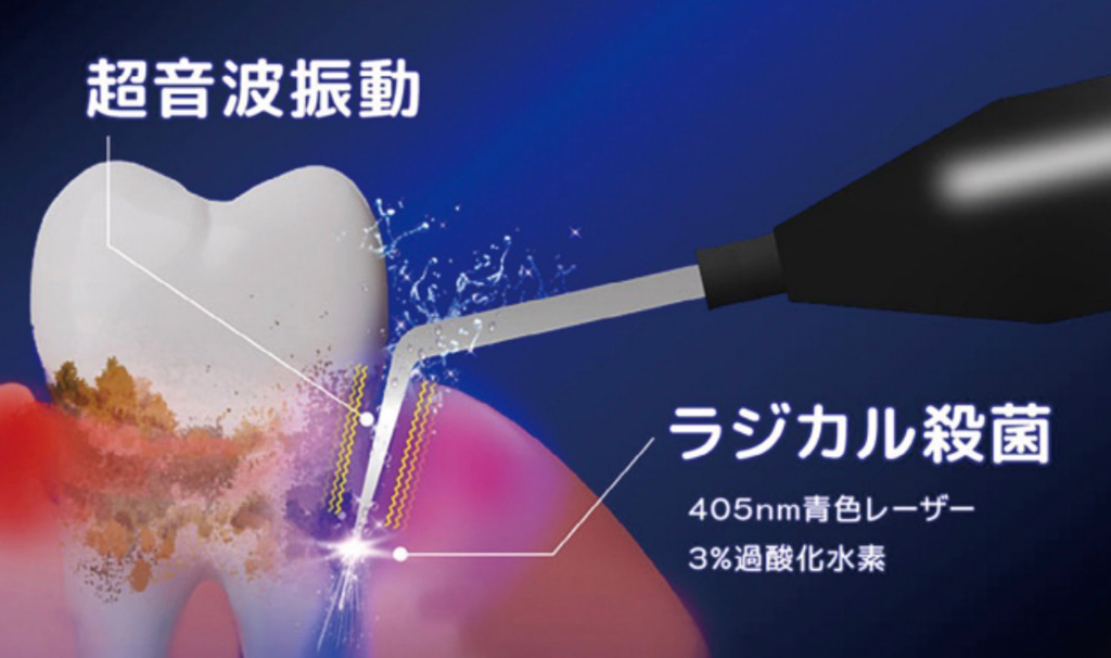 ブルーラジカルの歯周病治療